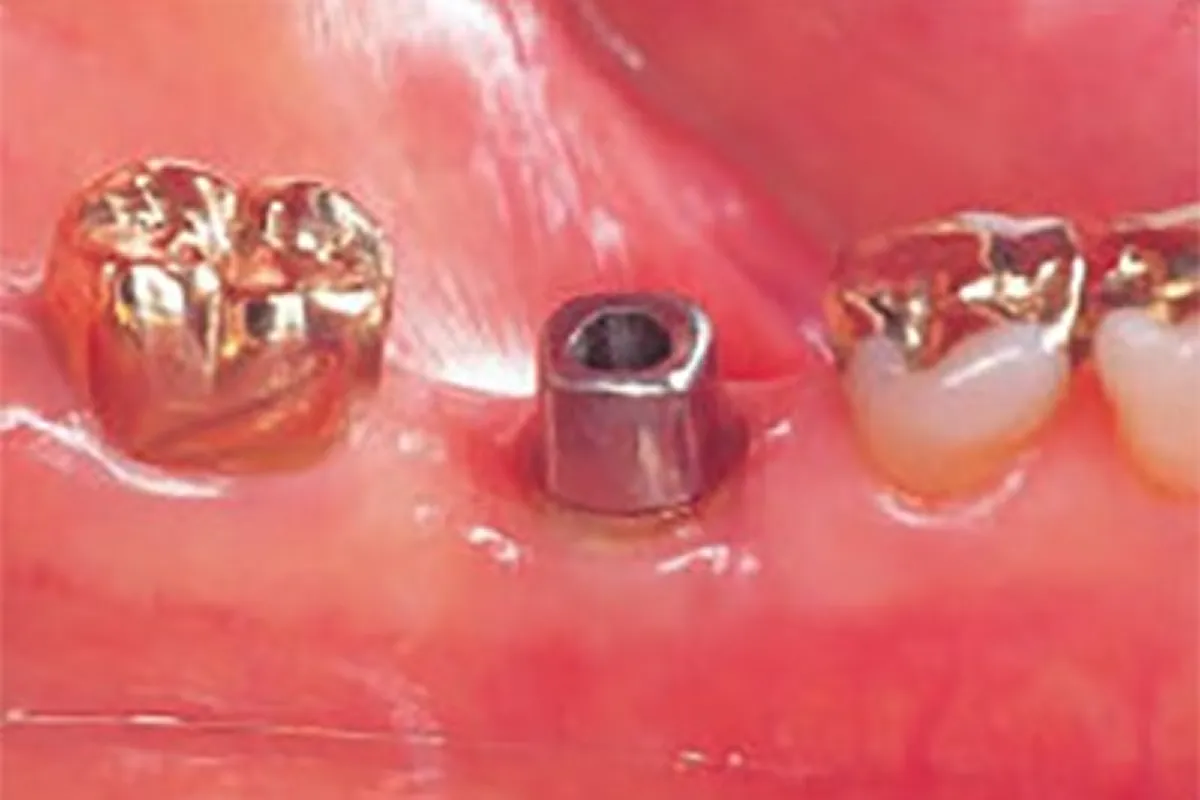 インプラントを埋め込む